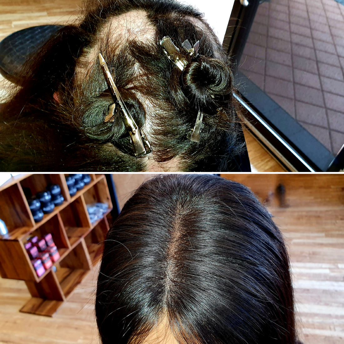 Trichotillomania Recovery: Elite Hair Australia’s Revolutionary Non-Invasive Hair Regrowth System”