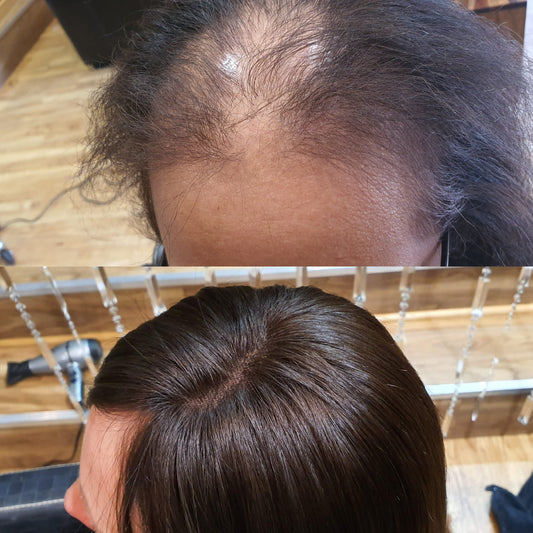 Woman Hair Loss Solution